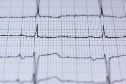 heart rhythm trace