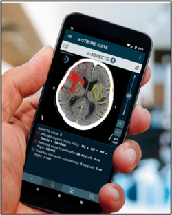 Brainomix software on smartphone