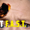 An image from the ACT F.A.S.T. campaign featuring the top half of a person's face with a small fire burning above one eye